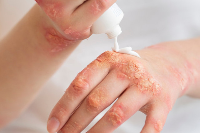 Desvelando los secretos de la psoriasis: causas, síntomas y opciones de tratamiento.